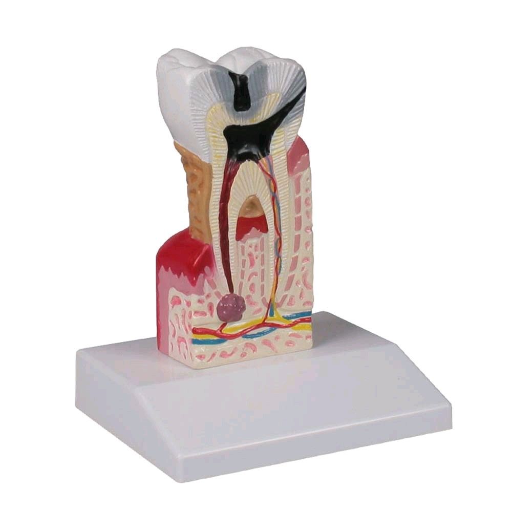 Zahnkariesmodell von Erler Zimmer, unteren Molar, 10-fach vergrößert